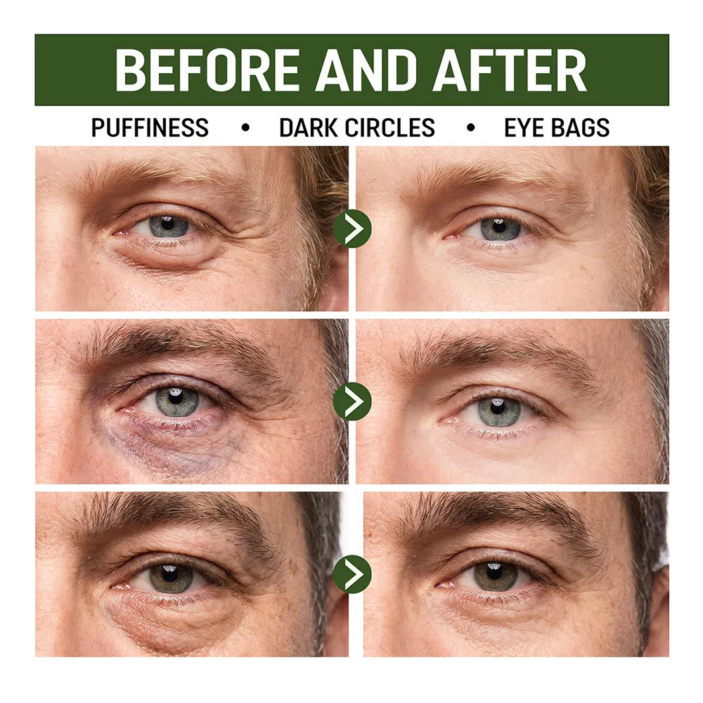 Before-and-after comparison showing the improved appearance of under-eye puffiness, dark circles, and eye bags.