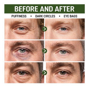Before-and-after comparison showing the improved appearance of under-eye puffiness, dark circles, and eye bags.