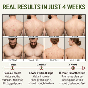 Four-week before-and-after results for body acne and folliculitis on the back and chest with ABERA Folliculitis Shower Gel.