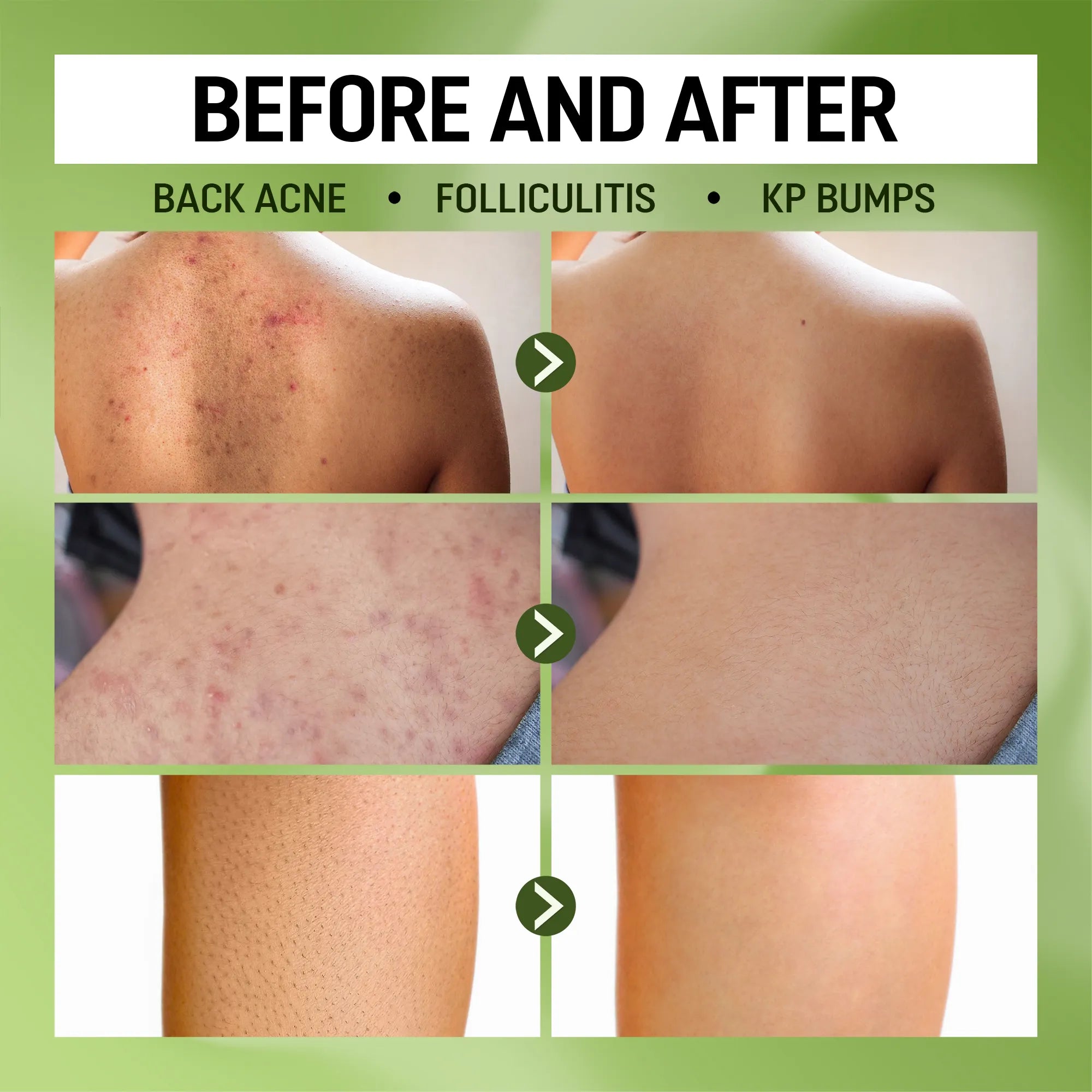 Before-and-after skin results showing reduced back acne, folliculitis and KP bumps with ABERA Folliculitis Shower Gel.