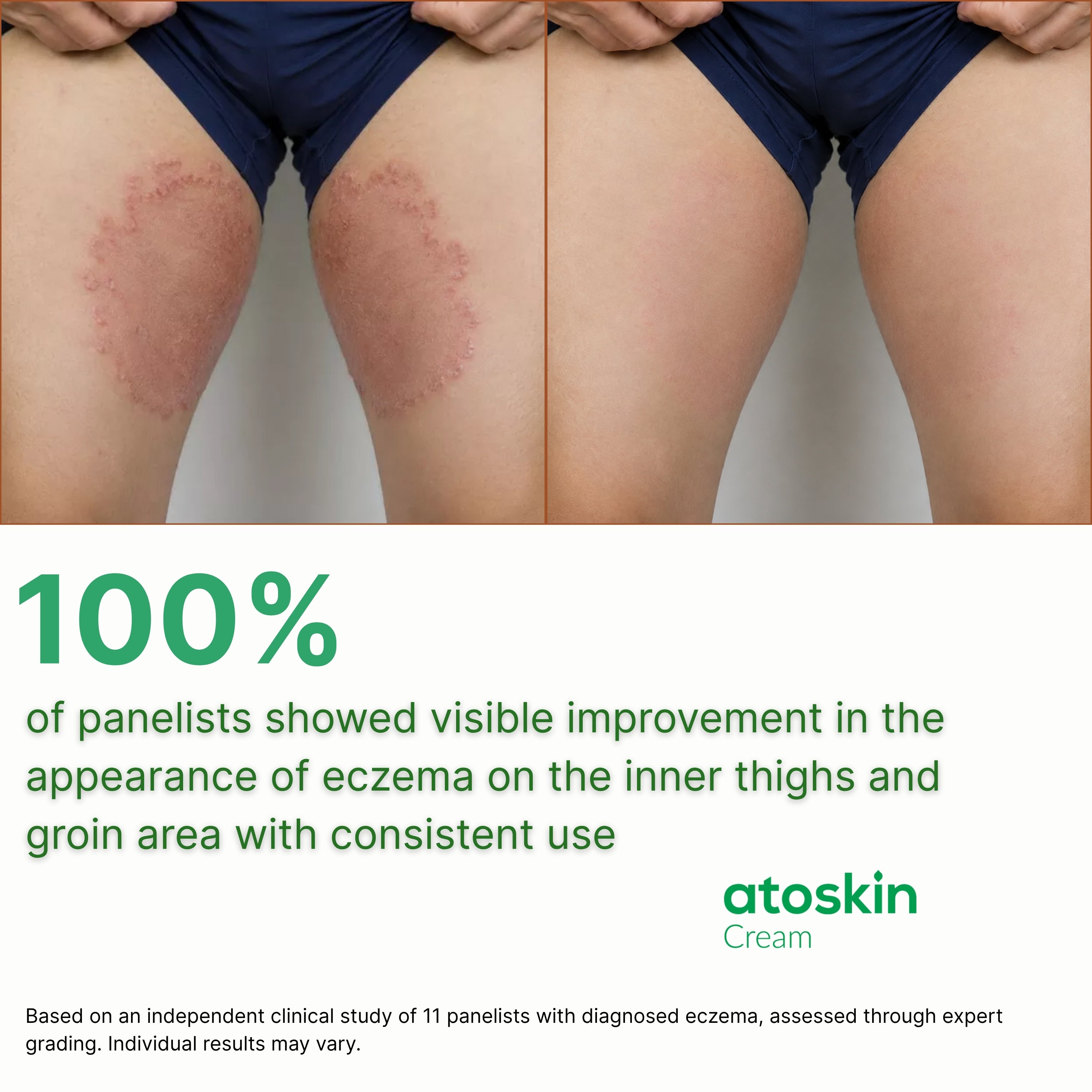 Atoskin Cream for Eczema & Psoriasis